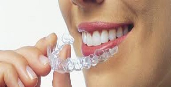 incognito Invisalign