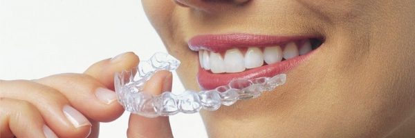 appareil-dentaire-invisalign