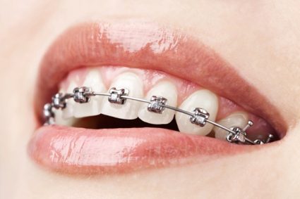Bagues - orthodontie