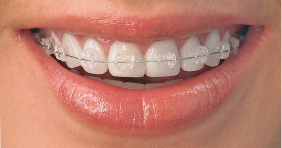 Bagues - orthodontie